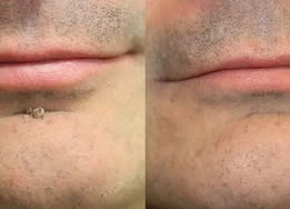 ✨✨ShapeOil®2-in-1 Microneedle & Hydrocolloid Patch🍀| Removes Raised Moles, Acne, Flat Warts & Skin Tags | Helps Improve Wrinkles, Scars & Blemishes | Invisible Patches for Face & Body