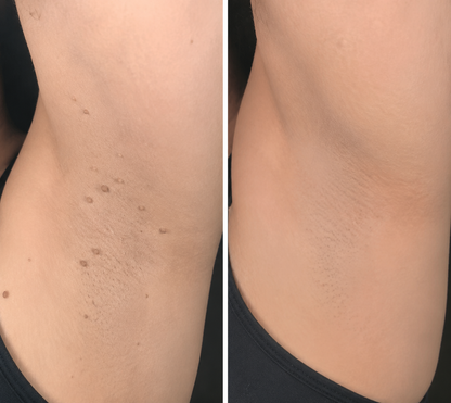 ✨✨ShapeOil®2-in-1 Microneedle & Hydrocolloid Patch🍀| Removes Raised Moles, Acne, Flat Warts & Skin Tags | Helps Improve Wrinkles, Scars & Blemishes | Invisible Patches for Face & Body