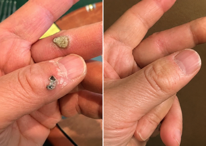 ✨✨ShapeOil®2-in-1 Microneedle & Hydrocolloid Patch🍀| Removes Raised Moles, Acne, Flat Warts & Skin Tags | Helps Improve Wrinkles, Scars & Blemishes | Invisible Patches for Face & Body